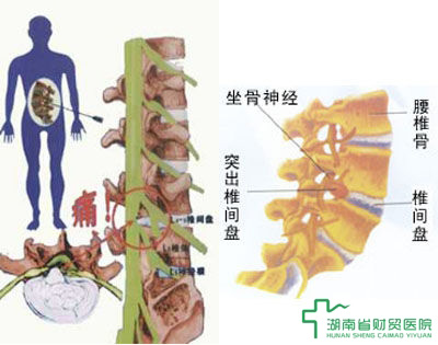 腰椎间盘突出最新疗法，探索与创新的治疗途径